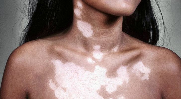 Білі плями - Як лікувати білі плями на шкірі?
