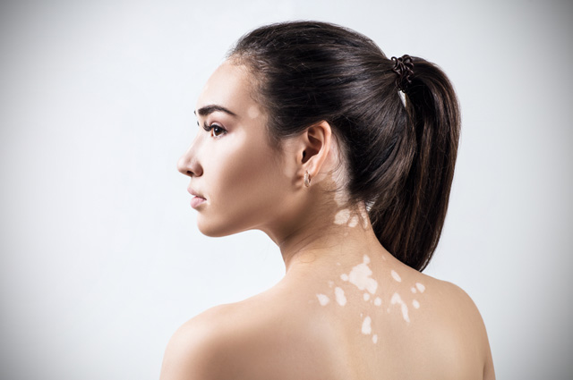 Білі плями - Як лікувати білі плями на шкірі?