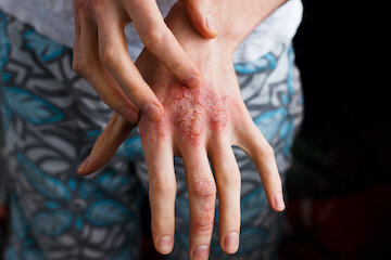 Дерматит рук - Які прчини, профілактика та лікування дерматиту рук?