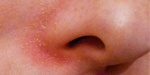 Шкіра - Які причини сухої шкіри навколо носа?