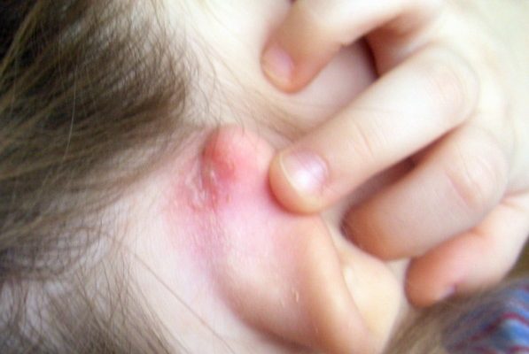 Суха шкіра за вухами - Які причини, лікування та профілактика?