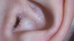 Суха шкіра за вухами - Які причини, лікування та профілактика?