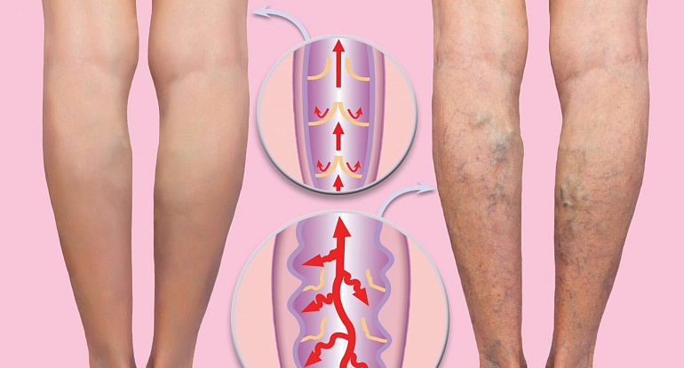 Варикоз и риск тромбоза: почему это важно?