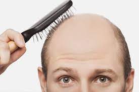 Випадіння волосся - Які є етапи випадіння волосся?